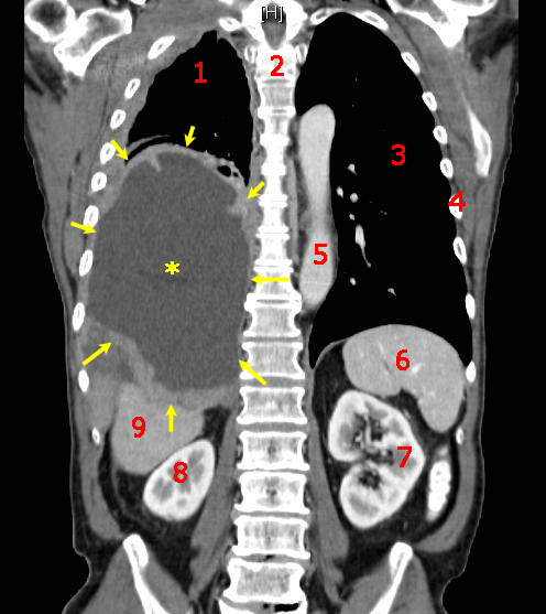 Resultados alentadores de una vacuna contra el  mesotelioma en fase I